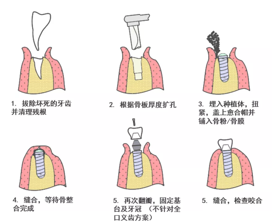 南漳县人民医院首例上颌窦外提升种植手术顺利实施 - 南漳县人民医院-县医院